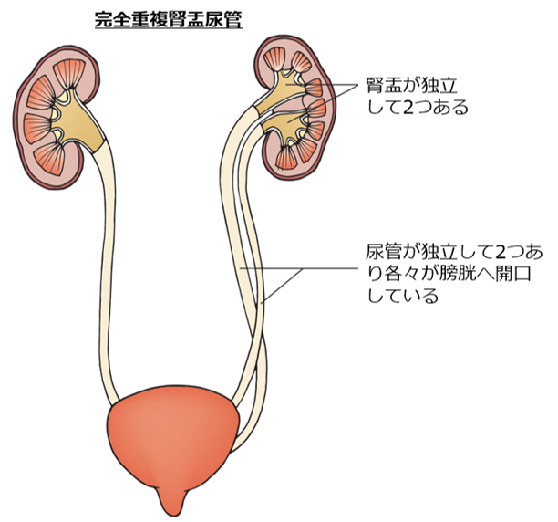 重複腎盂尿管とは