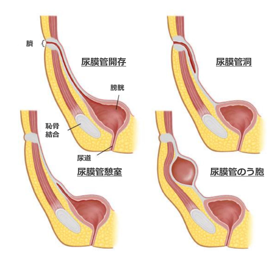 尿膜管遺残の形態